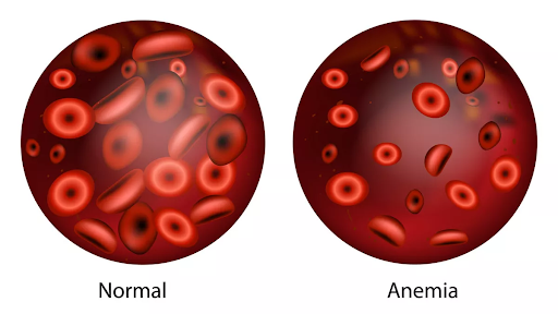 Anemia