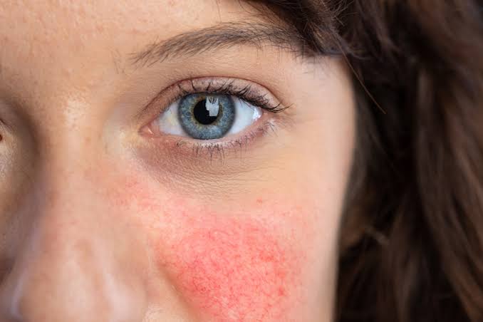 Rosacea