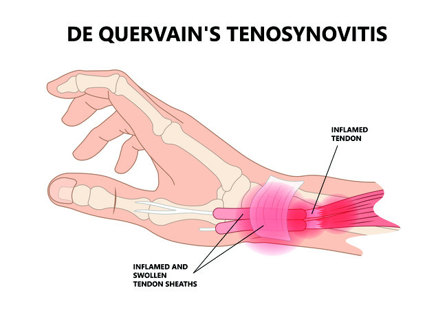 Sindrom De Quervain