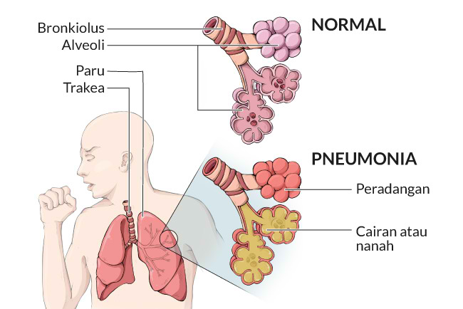 Pneumonia