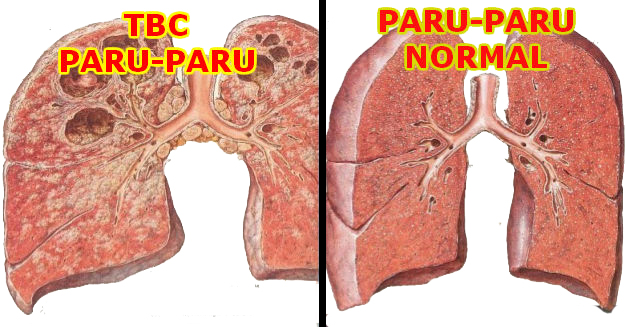 Tuberkulosis