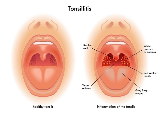 Apa Itu Tonsilitis