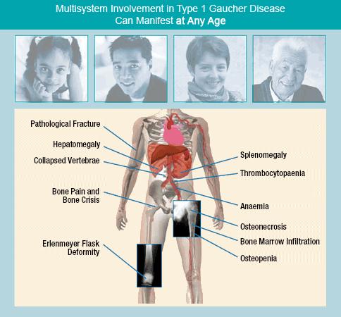 Gaucher Disease