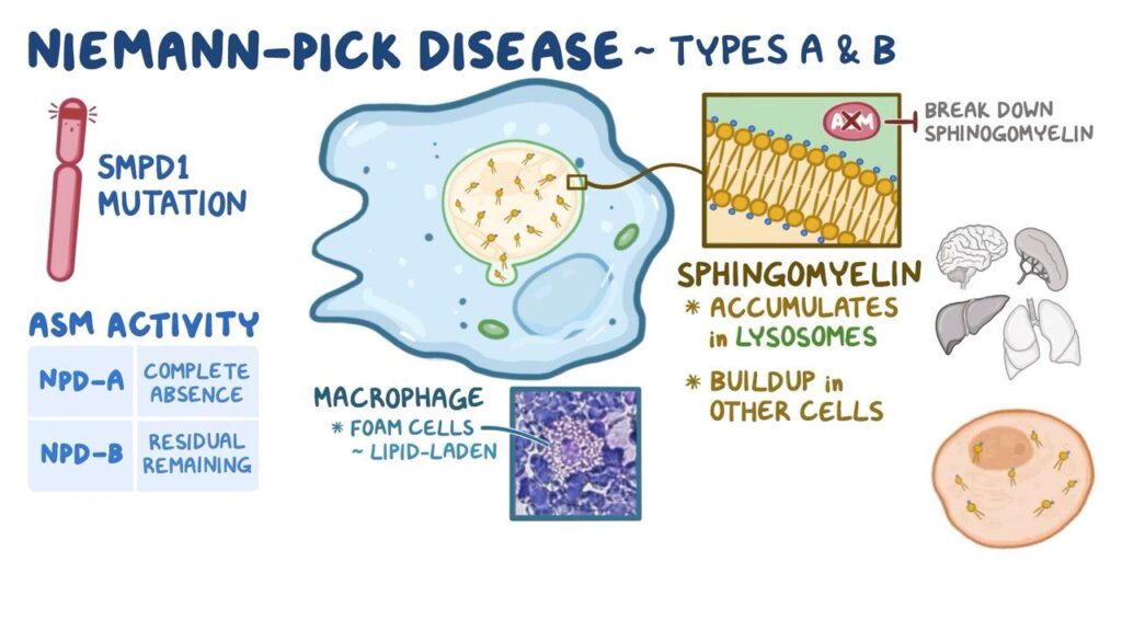 Niemann pick Disease