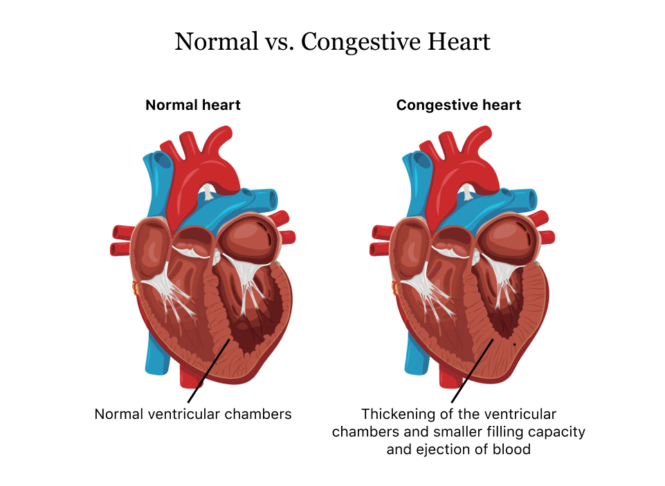 Normal vs. Congestive Heart