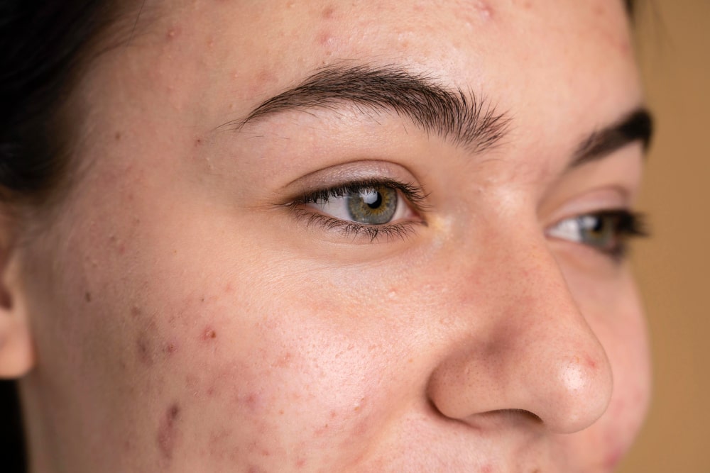 Apa Itu Fungal Acne Pengertian Penyebab Ciri Gambar And Pengobatan 