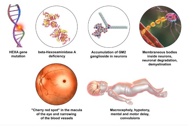 Tay sachs Disease