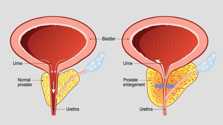 benign prostatic hyperplasia 722x406 1