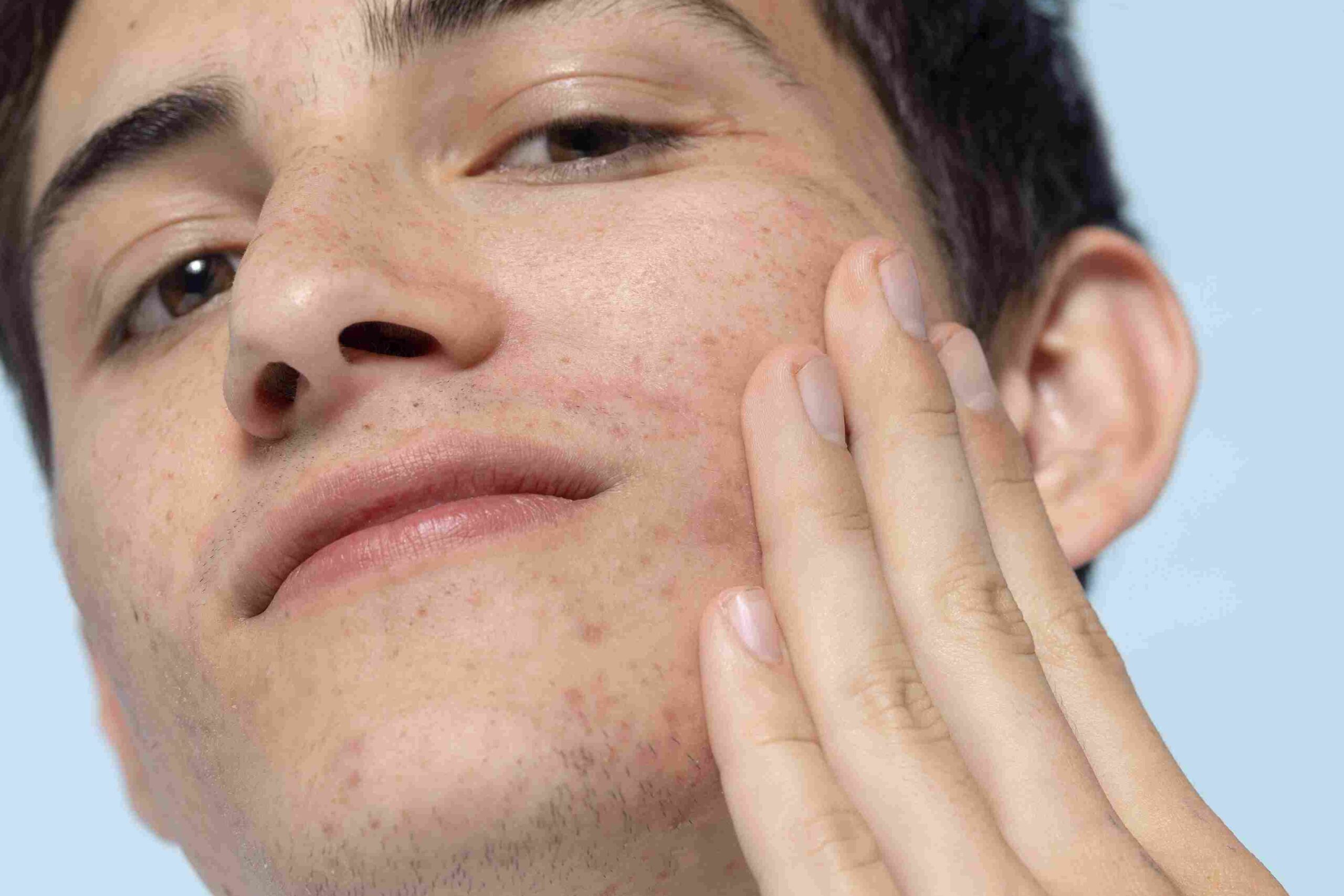 5 Produk Skincare Pria untuk Kulit Berminyak dan Berjerawat