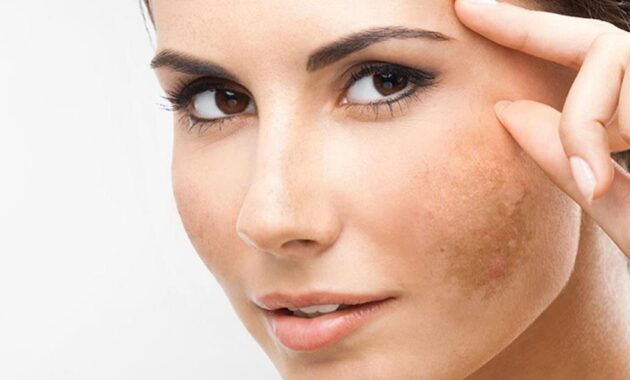 ampuh 5 tips cegah kemunculan flek hitam agar wajah tetap cantik 169